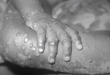 V Sloveniji potrjen prvi primer opičjih koz